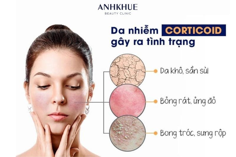 IPL giúp cải thiện các vấn đề đỏ da, nổi mụn li ti, xung huyết… do nhiễm độc Corticoid