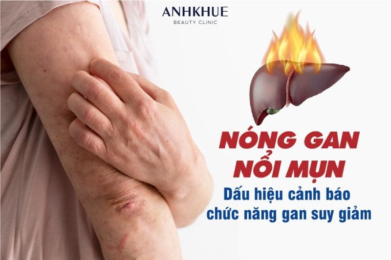 Sự tăng tiết dầu và bít tắc lỗ chân lông khiến nhiều người uống thuốc giải độc gan trị mụn