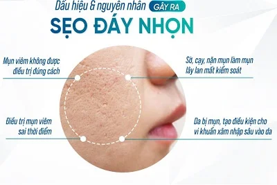 Sẹo đáy nhọn là một loại sẹo cứng đầu, khó nhất đòi hỏi cần sự tỉ mỉ và điều trị bằng phương pháp chuẩn y khoa