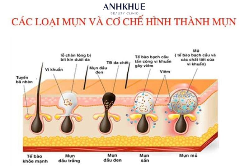 Mỗi loại mụn khác nhau cần có những cách điều trị khác nhau để mang lại hiệu quả tốt nhất