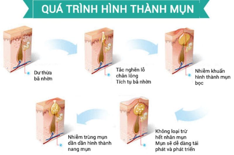 Mụn thường gặp ở độ tuổi thanh thiếu niên, bắt đầu từ 7-12 tuổi và kéo dài đến sau 30 tuổi