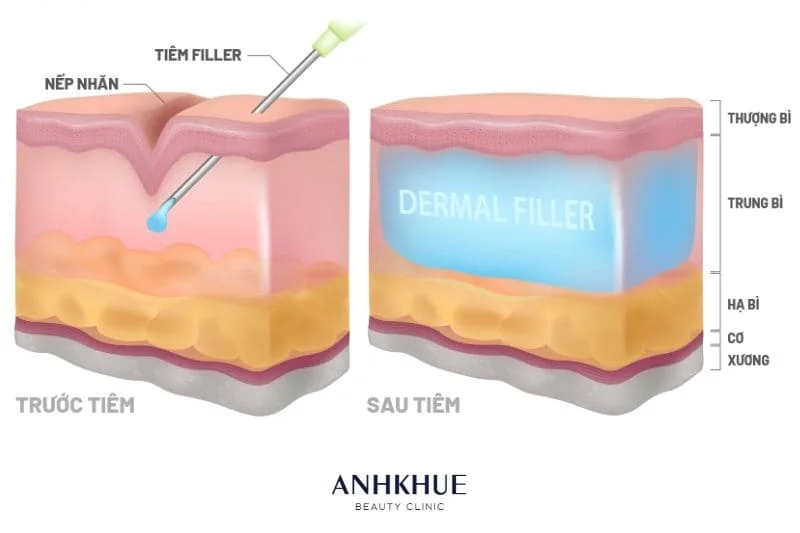 Kết quả tiêm Filler có thể nhìn thấy ngay lập tức và kéo dài trong vài tháng hoặc vài năm, tùy theo vị trí tiêm và loại chất làm đầy da