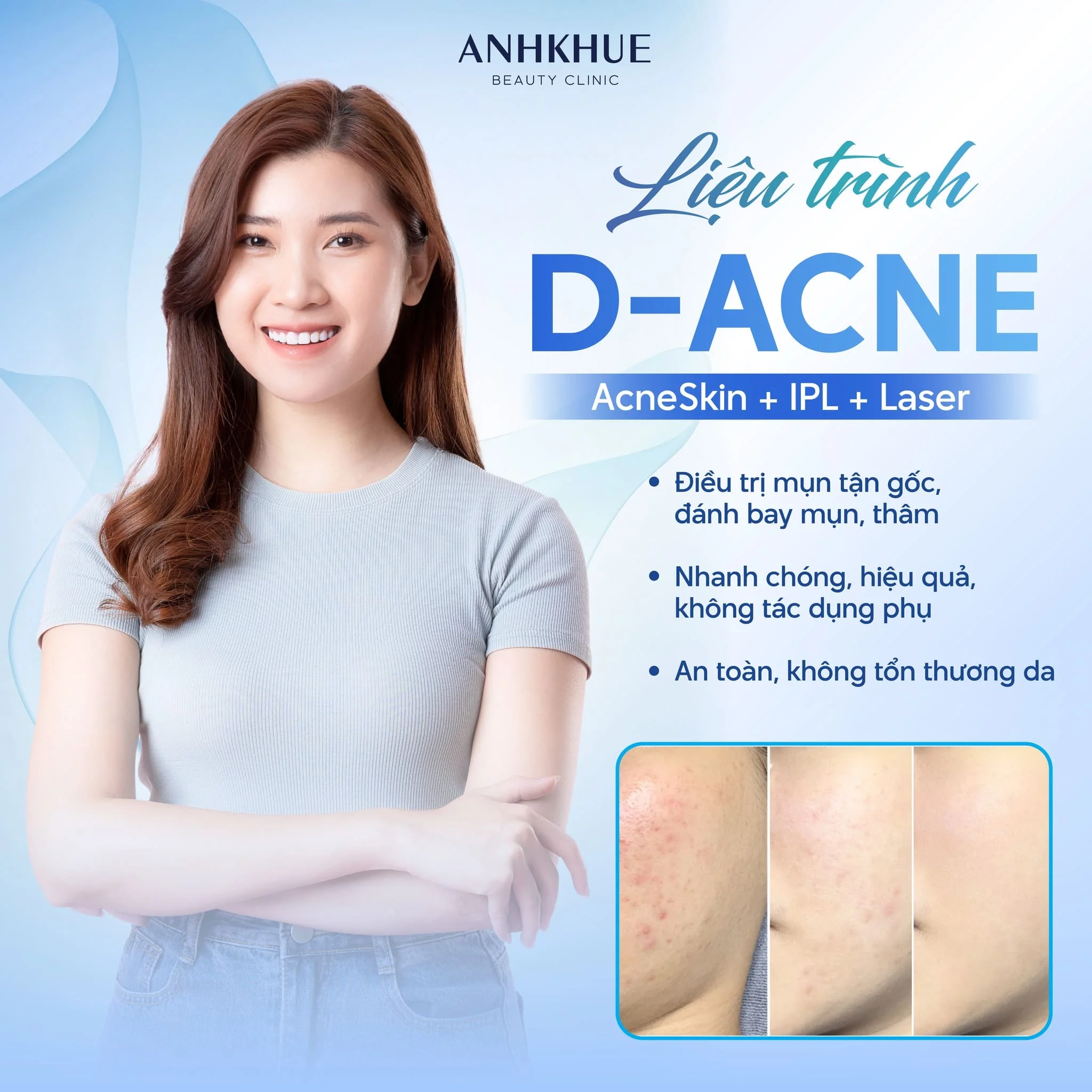 D-ACNE liệu trình điều trị mụn chuyên sâu chuẩn Y khoa, kết hợp 3in1 Acneskin + IPL + Laser Renew Skin