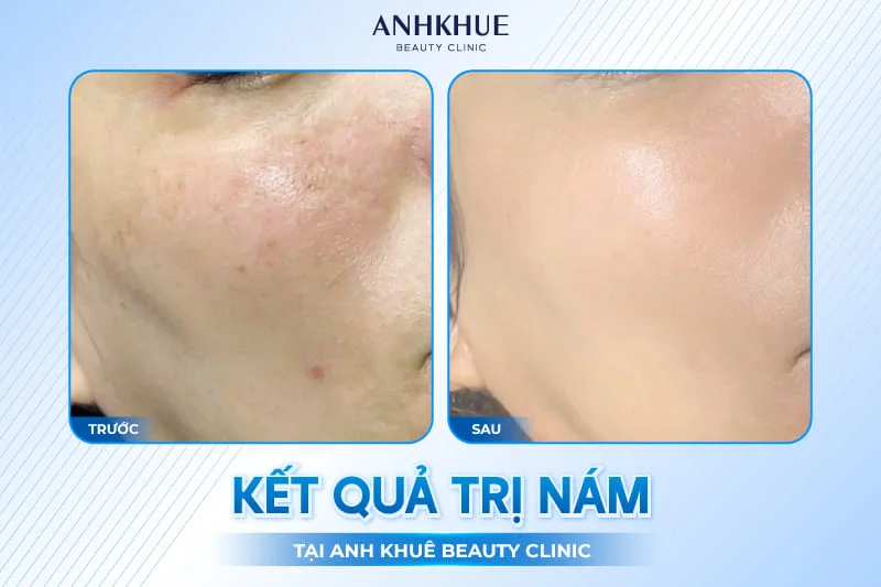 Khách hàng thực hiện điều trị Nám tại Anh Khuê Beauty Clinic