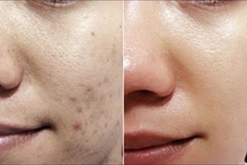 Skin Detox tại Anh Khuê mang  lại làn da trắng hồng, đều màu, căng mịn, và sạch mụn, tăng cường đề kháng cho da