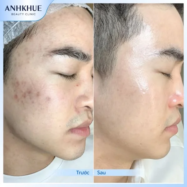 Kết quả điều trị mụn tại Anh Khuê Beauty Clinic