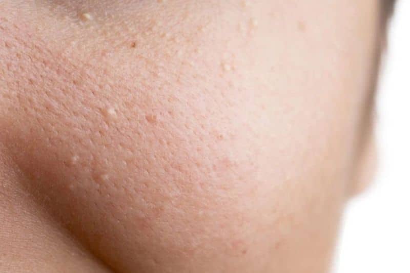 Mmụn ẩn là do tuyến bã nhờn hoạt động mạnh khiến cho lỗ chân lông bị bít tắc, từ đó tạo điều kiện cho vi khuẩn xâm nhập gây mụn
