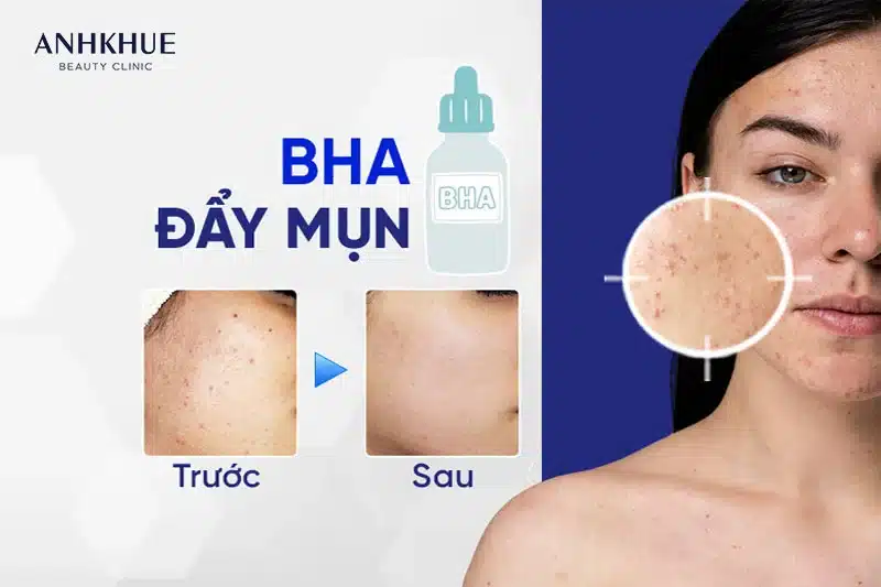 BHA làm tăng lượng dầu và bã nhờn trong lỗ chân lông, dẫn đến tắc nghẽn và bùng phát mụn ẩn