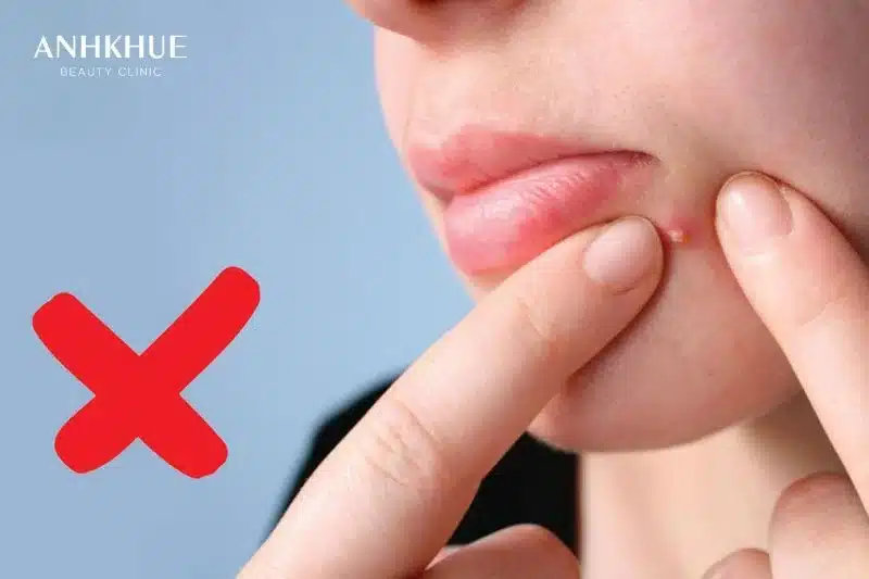 Lấy nhân mụn bằng tay dễ bị nhiễm khuẩn gây viêm