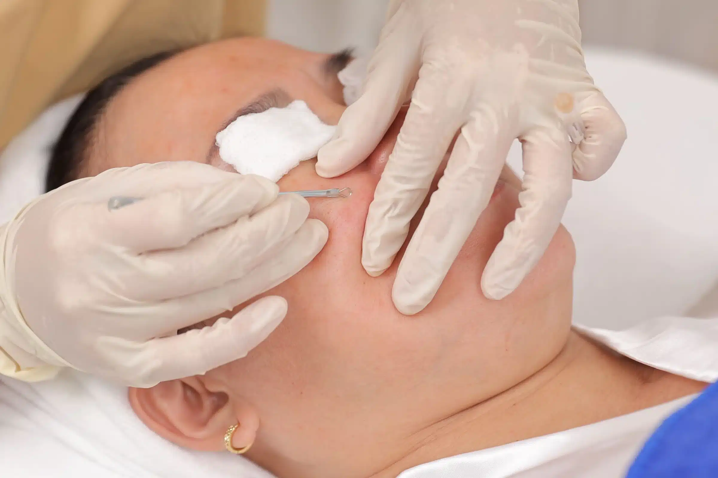Liệu trình Acneskin điều trị mụn tác động sâu vào gốc rễ của mụn, loại bỏ nhân mụn và ngăn chặn mụn tái phát