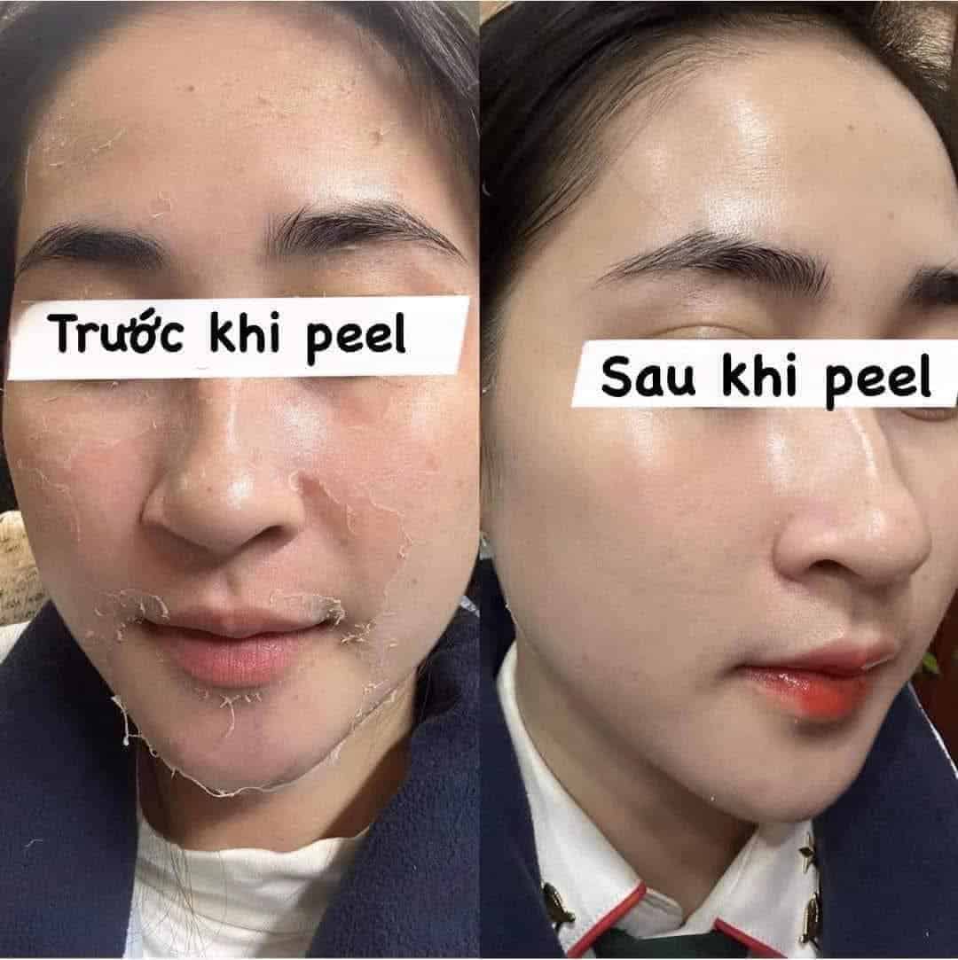 Peel da mang lại hiệu quả cao trong điều trị mụn, lỗ chân lông to, sắc tố và lão hóa da