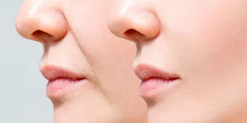 Rãnh cười tuy không tác động xấu đến sức khỏe nhưng là "điểm trừ" trên khuôn mặt, khiến chị em trông kém sắc và già hơn tuổi thật