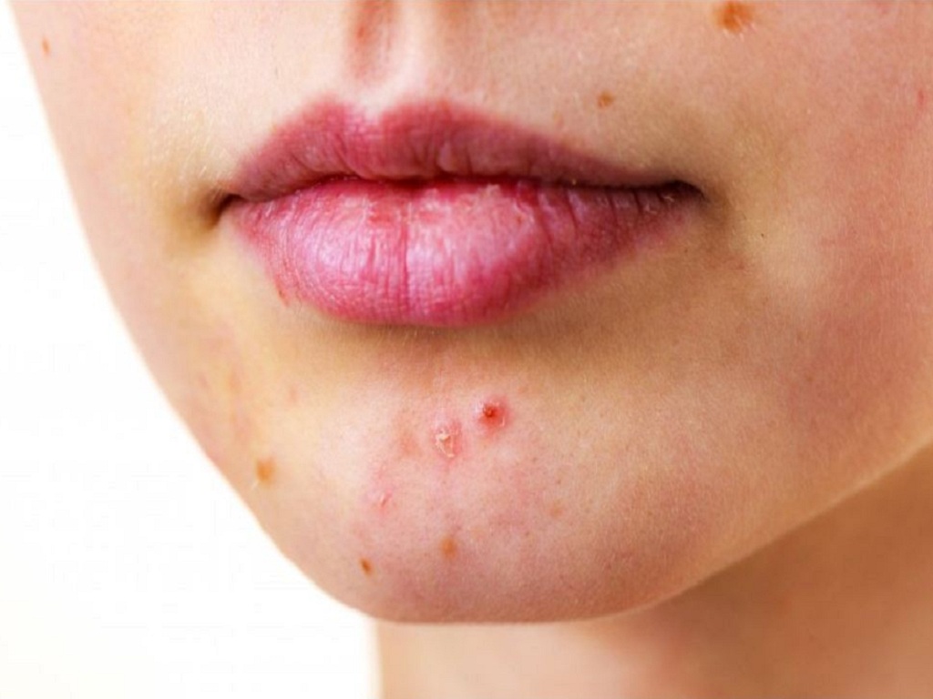 Mụn ở cằm do biến đổi hormone, rối loạn nội tiết tố hoặc sức khỏe buồng trứng, tử cung có vấn đề