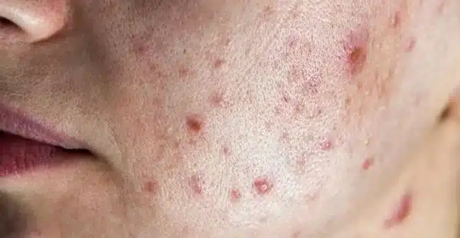 Má là vùng da tiết nhiều bã nhờn và dễ dàng tích tụ bụi bẩn gây mụn
