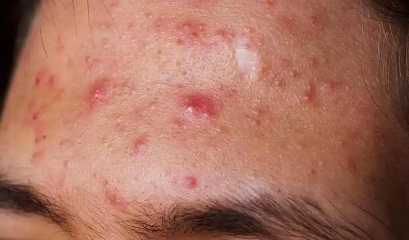 Mụn ở trán có thể là dấu hiệu cảnh báo vấn đề về hệ tiêu hóa