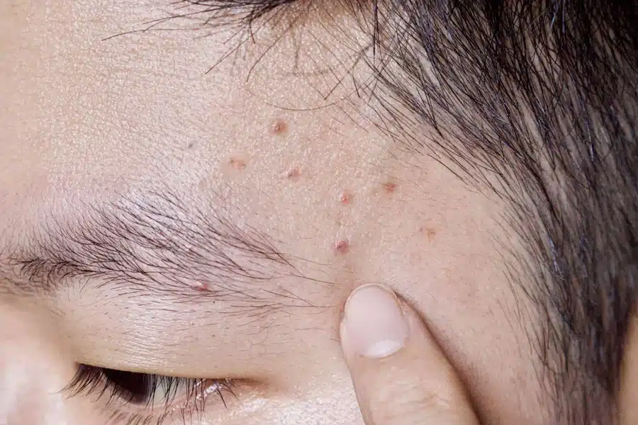 Mụn ở thái dương là dấu hiệu cảnh báo vấn đề sức khỏe về túi mật, túi dịch