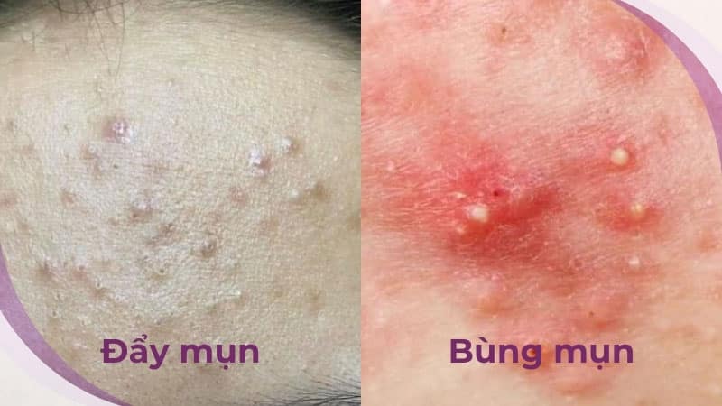 Sự khác biệt giữa hiện tượng “Đẩy mụn” với “Bùng phát mụn”