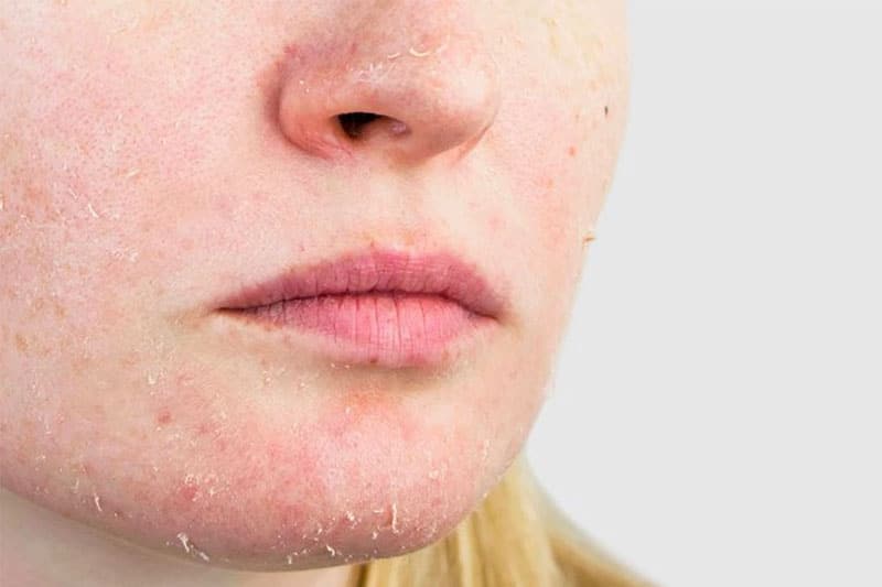 Da khô thường trông có vẻ mất nước, bong tróc, kích ứng, đôi khi gây đau và ngứa
