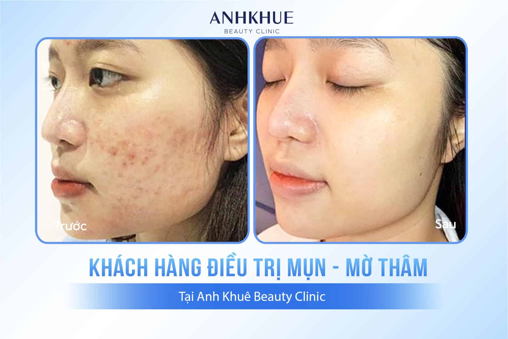 Hình ảnh khách hàng điều trị mụn chuẩn Y khoa tại Anh Khuê