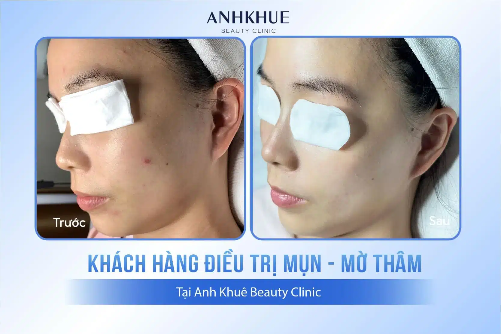 Hình ảnh khách hàng điều trị mụn chuẩn Y khoa tại Anh Khuê