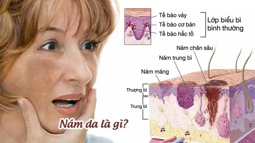 Nám da là biểu hiện của sự tăng hắc sắc tố melanin trên da đột ngột khiến da hình thành những vết sạm hoặc chấm nâu trên da làm ảnh hưởng tới thẩm mỹ, nhất là trên mặt