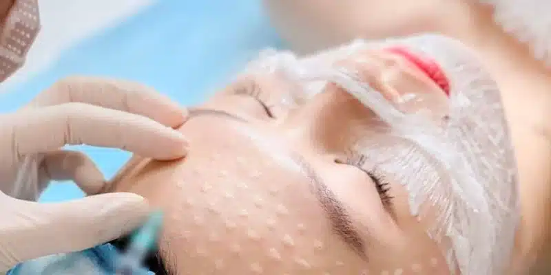 Cấy trắng giảm nám là phương pháp đưa tinh chất đặc trị vào vùng da bị nám để loại bỏ hắc tố gây nên những vùng da sậm màu