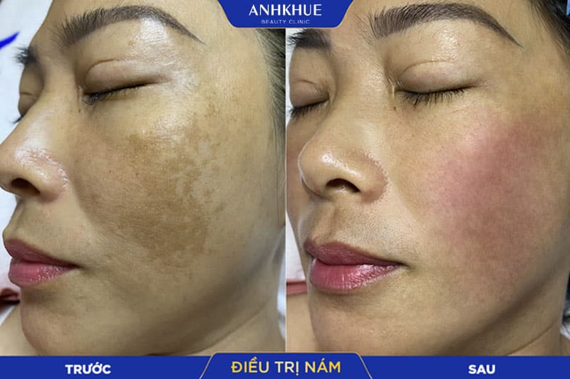 Combo 𝗗-𝗪𝗛𝗜𝗧𝗘 kết hợp độc quyền 3 công nghệ Melasma, Laser và Cấy trắng giảm nám đang được nhiều chị em săn đón tại nhà Anh Khuê