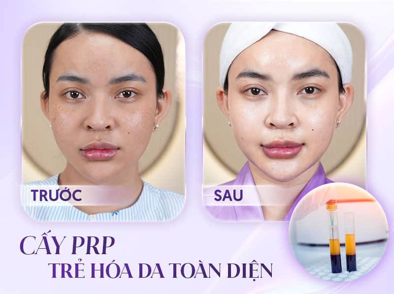 PRP giúp chị em phụ nữ sở hữu làn da trẻ đẹp, săn chắc và căng tràn sức sống