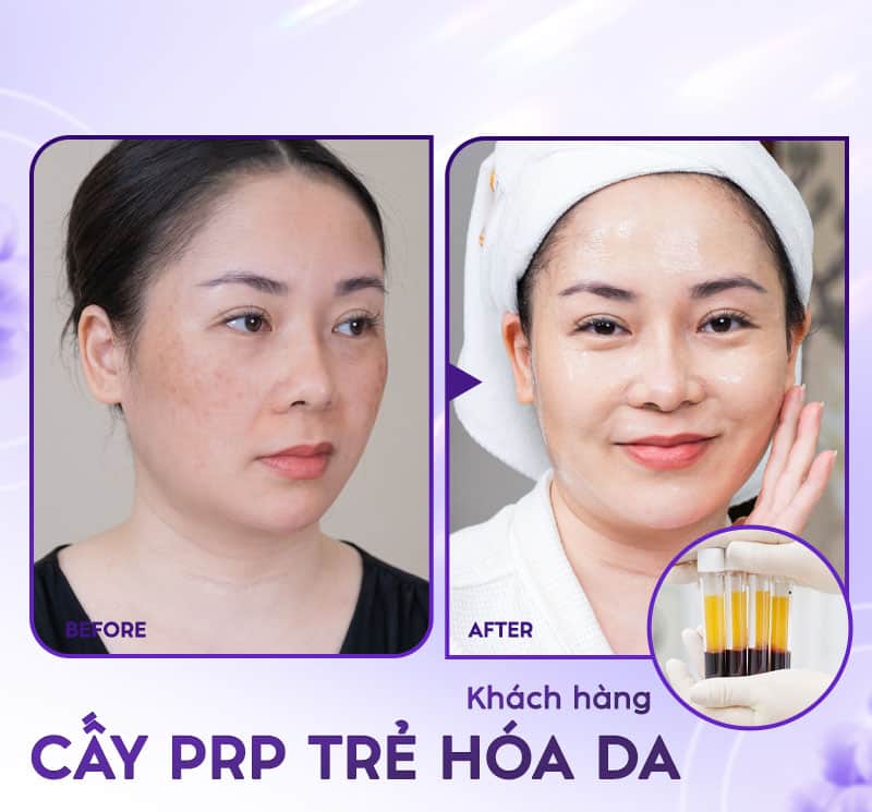 PRP giúp da khỏe hơn, tăng sức khỏe làn da và ngăn chặn nếp nhăn