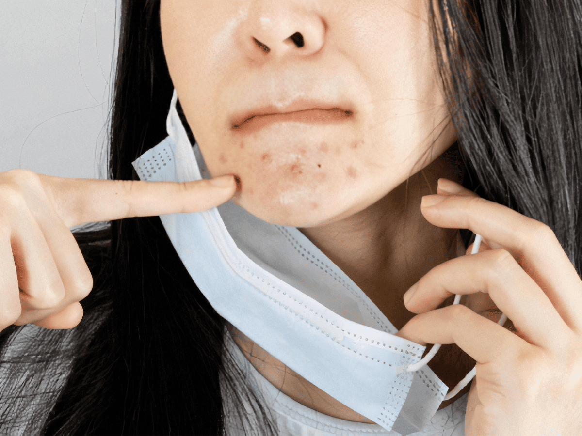 Đeo khẩu trang nhiều tạo môi trường lý tưởng cho vi khuẩn phát triển và gây mụn