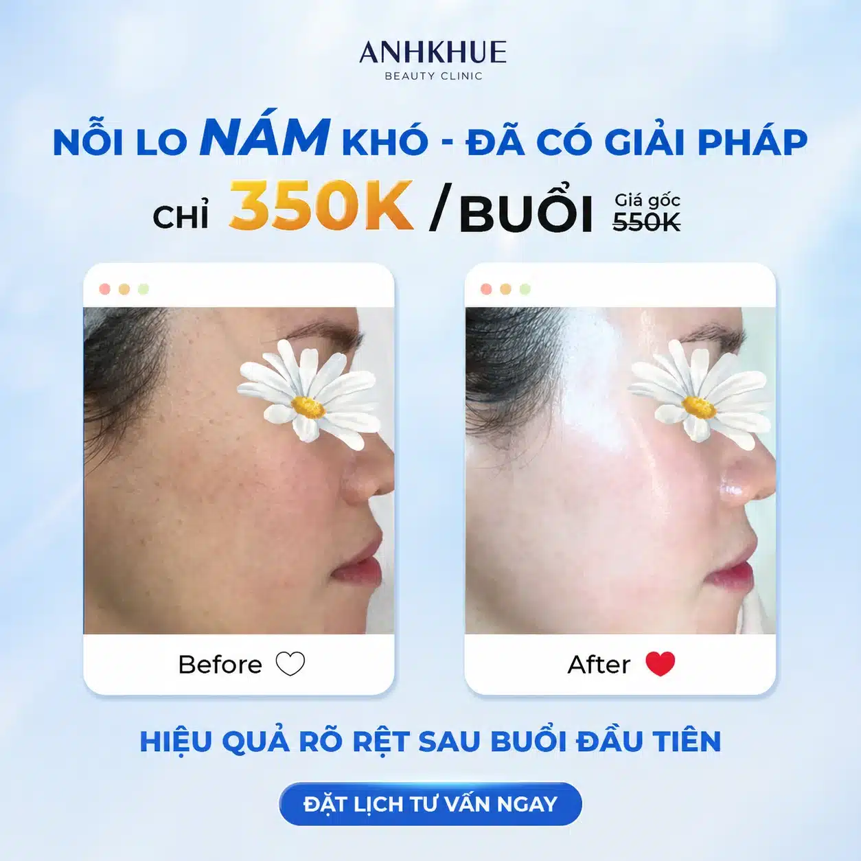 Ưu đãi Melasma giảm thâm nám, làm đều màu da và ngăn ngừa hình thành sắc tố chỉ 3𝟱𝟬𝗞/buổi (giá gốc 550K) tại Anh Khuê Beauty Clinic