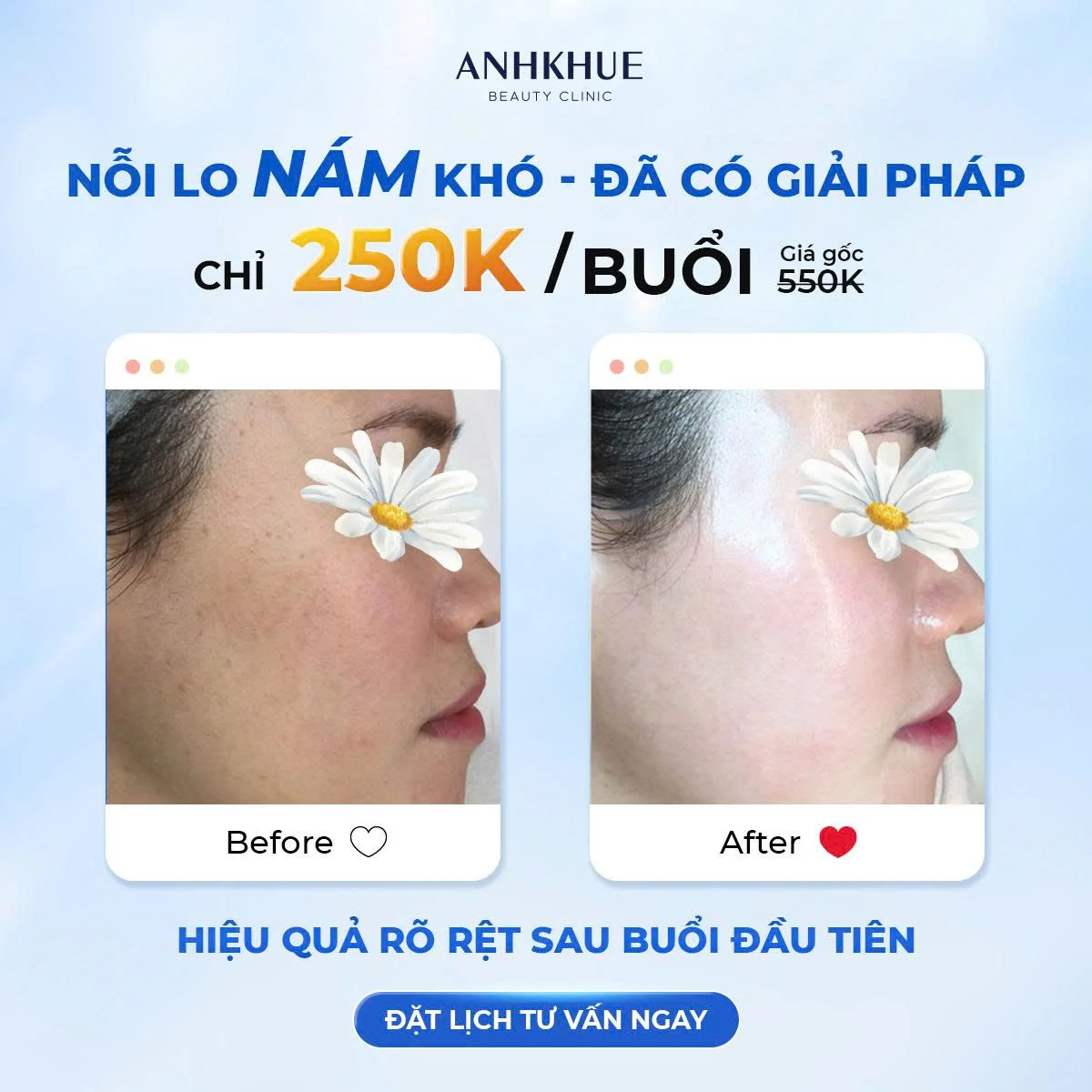 Ưu đãi Melasma chỉ 𝟮𝟱𝟬𝗞/buổi (giá gốc 550K) tại Anh Khuê Beauty Clinic