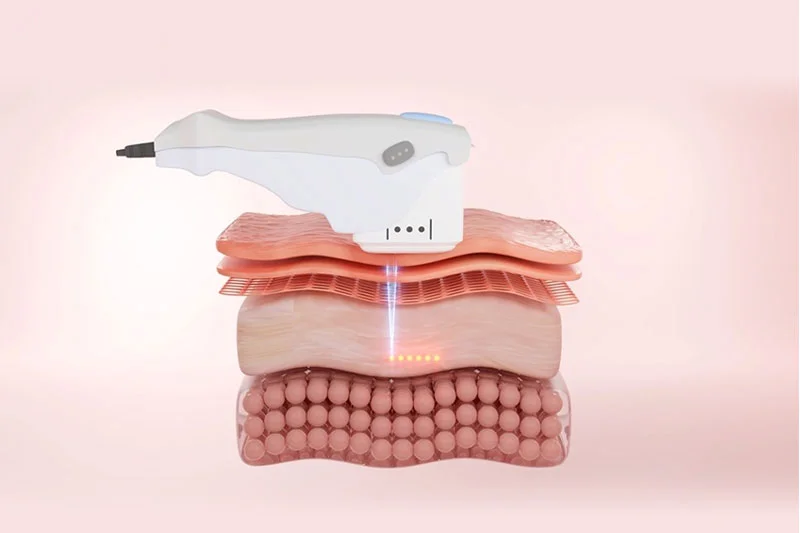 SMAS Hifu là công nghệ sử dụng sóng siêu âm hội tụ cường độ cao để làm săn chắc và nâng cao cấu trúc da một cách tự nhiên mà không cần phẫu thuật