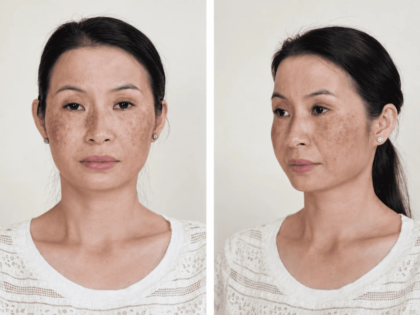 Nám chân sâu đi kèm da mỏng yếu và đỏ rát là báo động đỏ cho thấy hàng rào bảo vệ da đã bị tổn thương nặng
