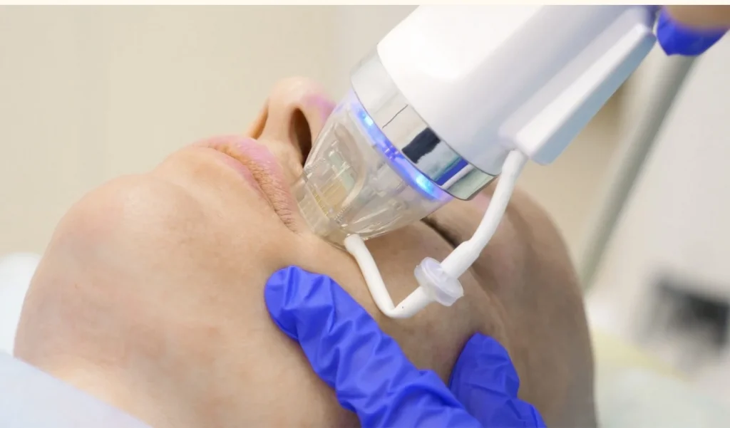 RF Needle sử dụng hệ thống vi kim kết hợp sóng RF để đưa năng lượng đến đúng tầng trung bì, kích thích cơ chế tái tạo tự nhiên của da