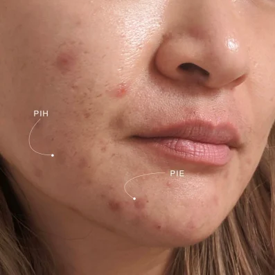 Thâm đỏ và Thâm đen là hai dạng tổn thương phổ biến sau khi điều trị mụn