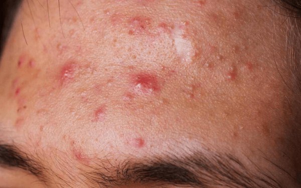 Mụn ẩn đã chuyển biến thành mụn viêm Khi mụn ẩn đã phát triển thành các đám lớn, đau, có dịch hoặc mủ trắng, sưng đau, đây là dấu hiệu của mụn đã chuyển sang tình trạng viêm.